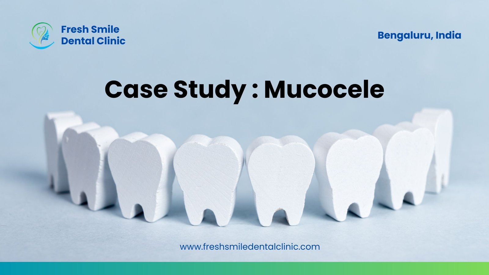 Mucocele Mysteries: A Comprehensive Case Study on Diagnosis, Treatment, and Patient Outcomes