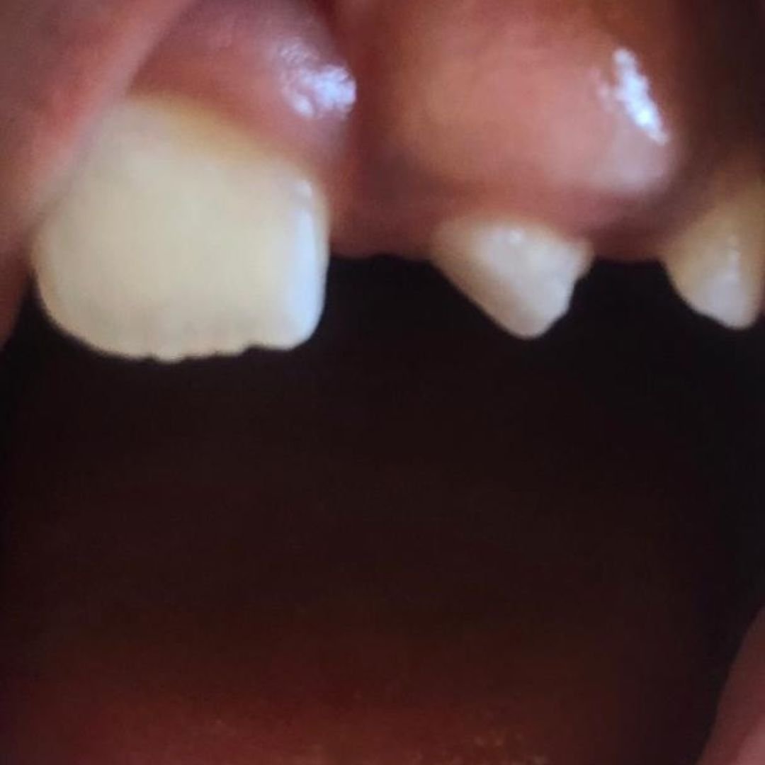 Pediatric Mesodens
