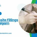 Composite Fillings vs Amalgam Fillings