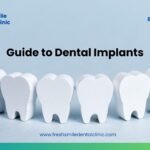 Step-by-Step Guide to Dental Implants